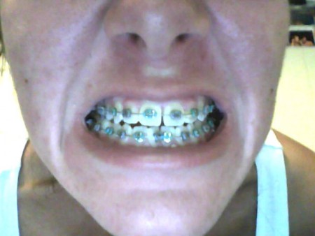 Teeth after 2 1/2 months