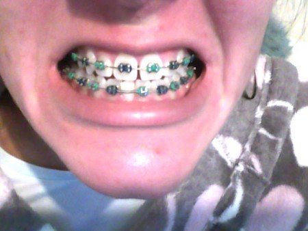 Teeth after 3 and a 1/2 months